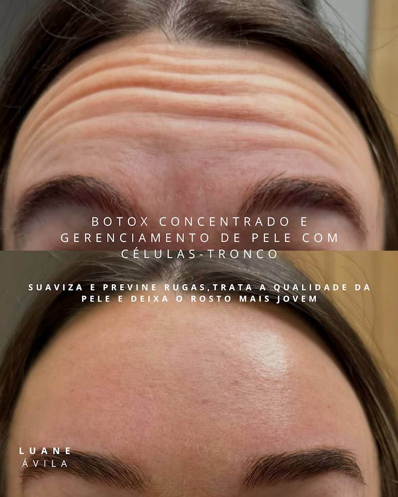 Botox & Bioestimulador de Colágeno — resultado 1