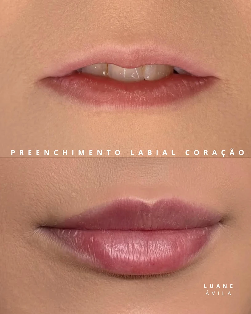 Preenchimento Labial – Efeito Coração — resultado 1