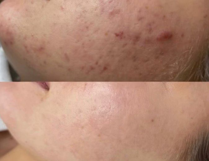 Laser Italiano para Rejuvenescimento e Cicatrizes de Acne — resultado 1