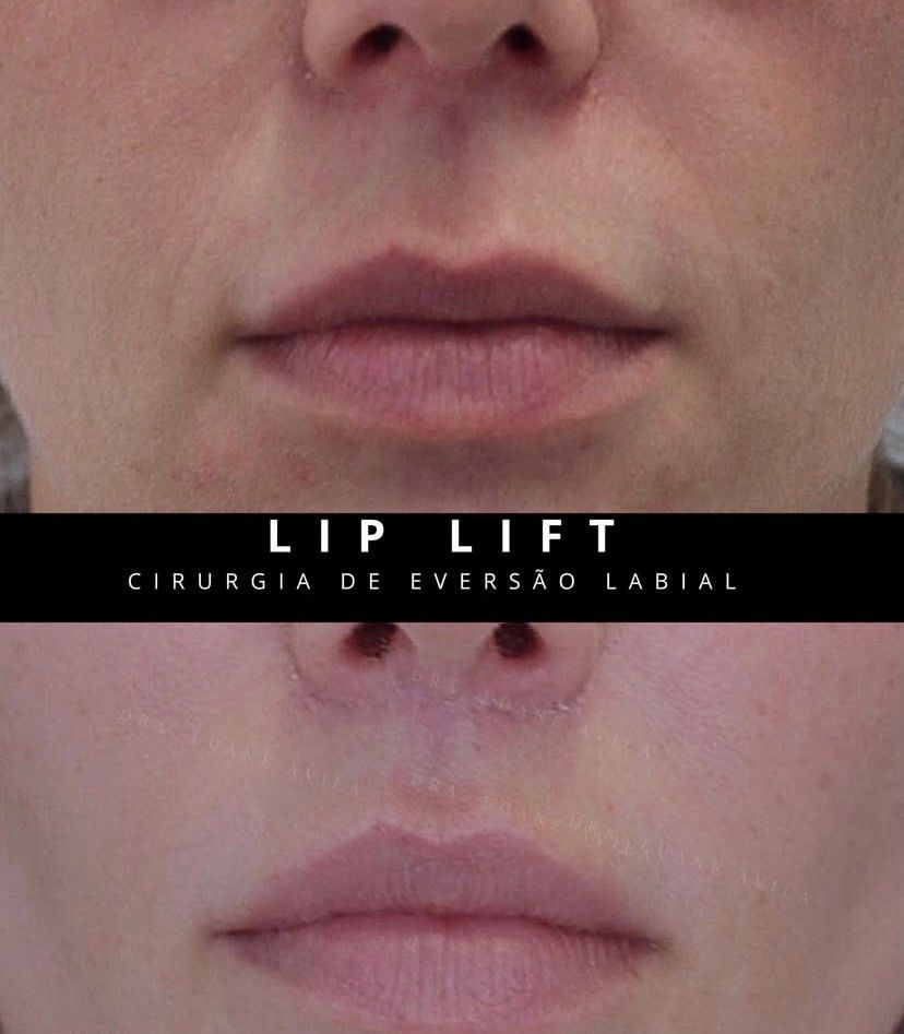 Lip Lift — resultado 1