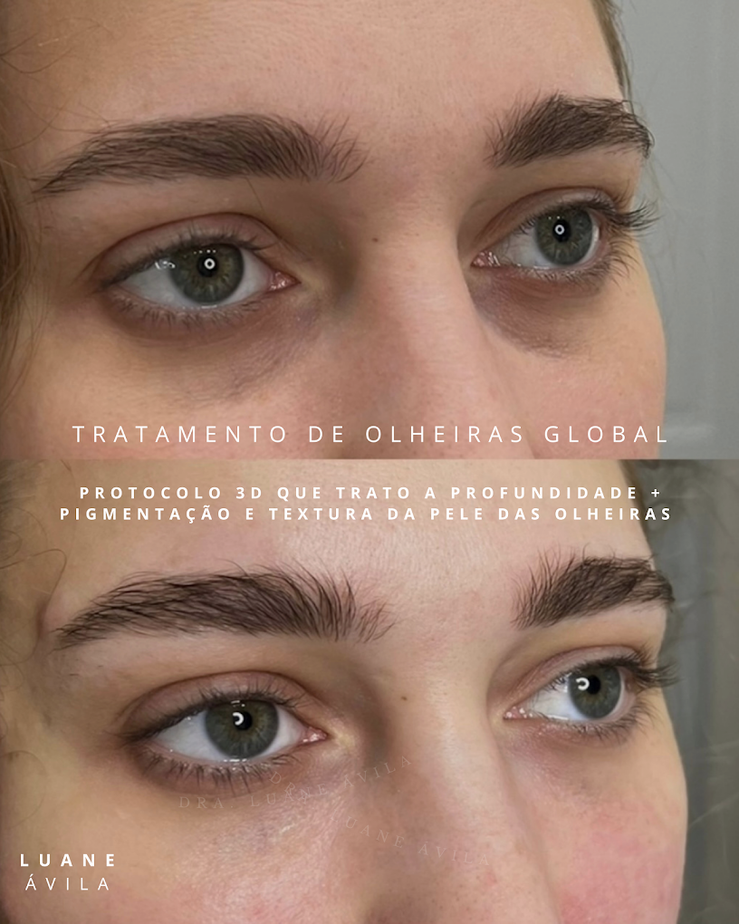 Tratamento de Olheiras — resultado 1