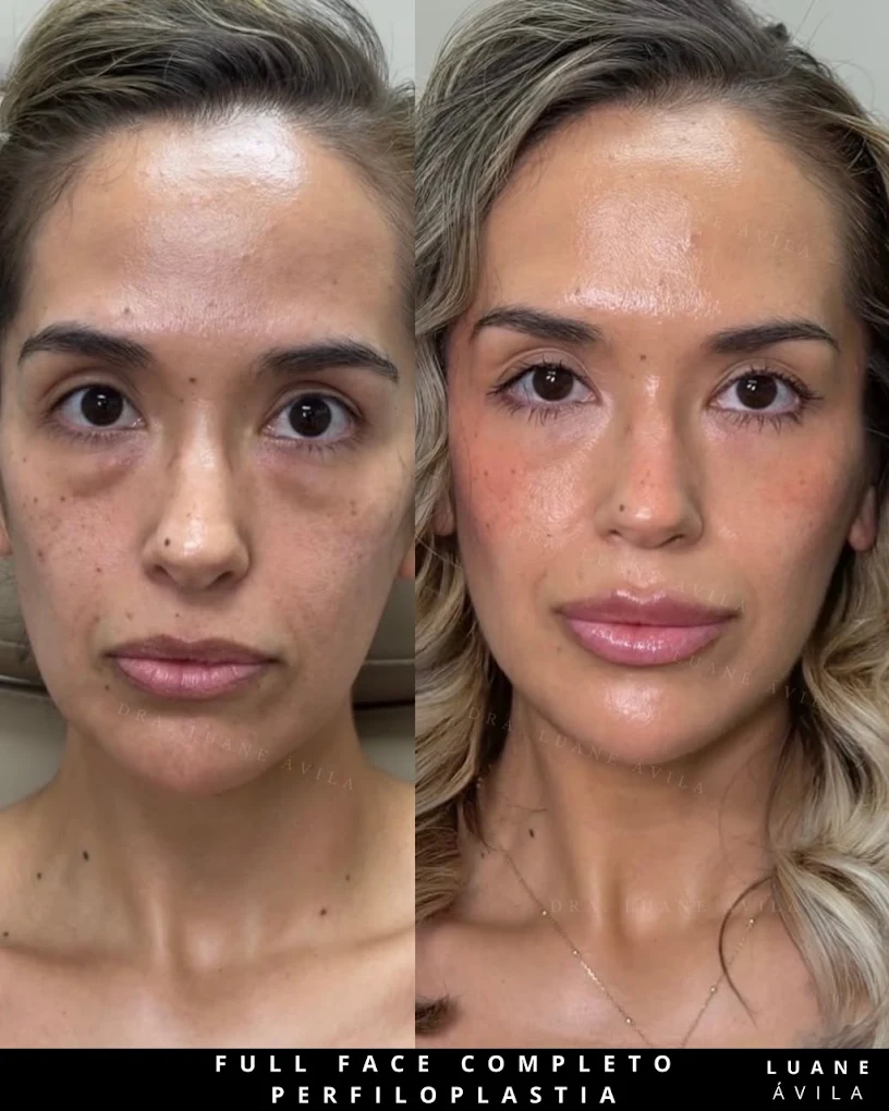 Perfiloplastia / Full Face — resultado 1