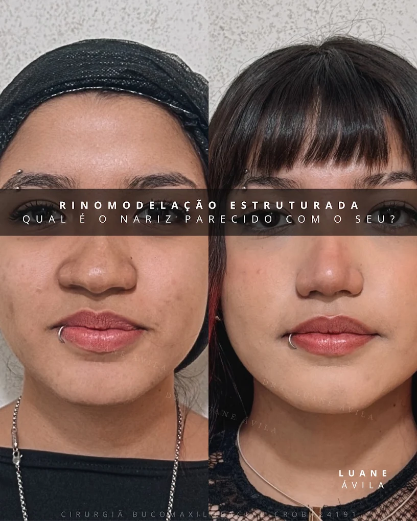 Rinomodelação Estruturada — resultado 1