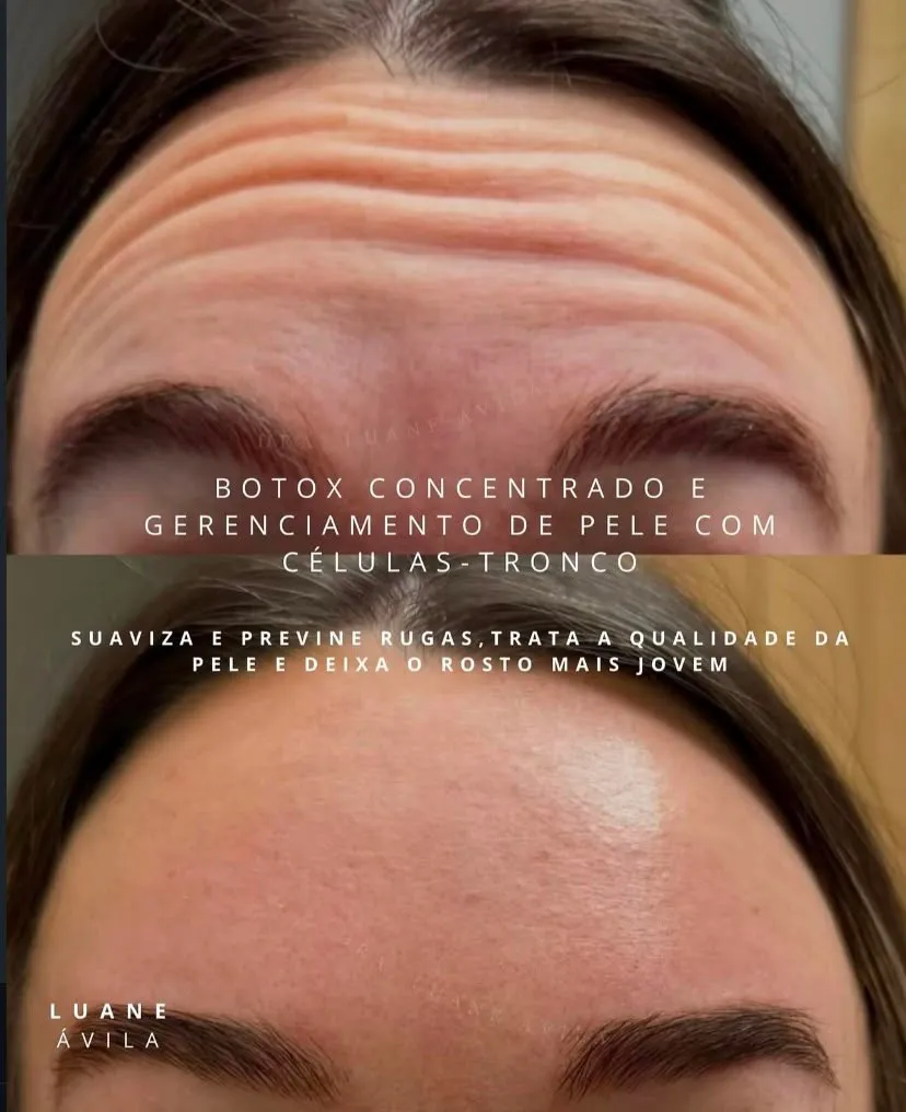 Resultado — Botox Concentrado e gerenciamento de pele com células-tronco, antes e depois