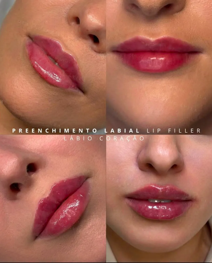 Resultado — Preenchimento Labial – Lábio Coração, resultado em quatro ângulos