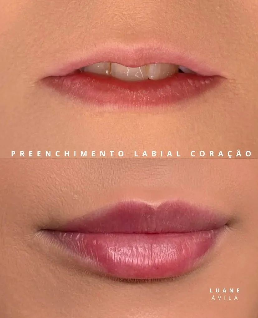 Resultado — Preenchimento Labial Coração, antes e depois em vista frontal