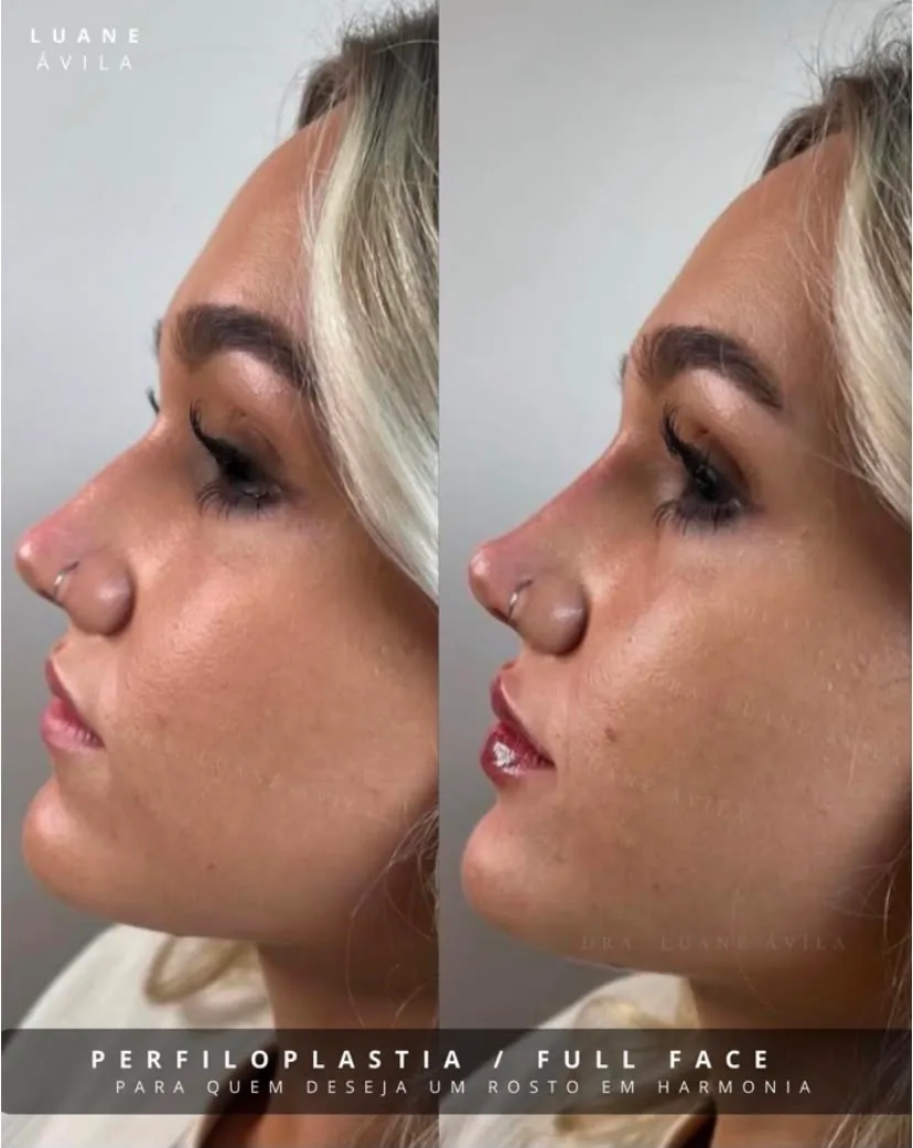 Resultado — Perfiloplastia / Full Face, antes e depois em perfil