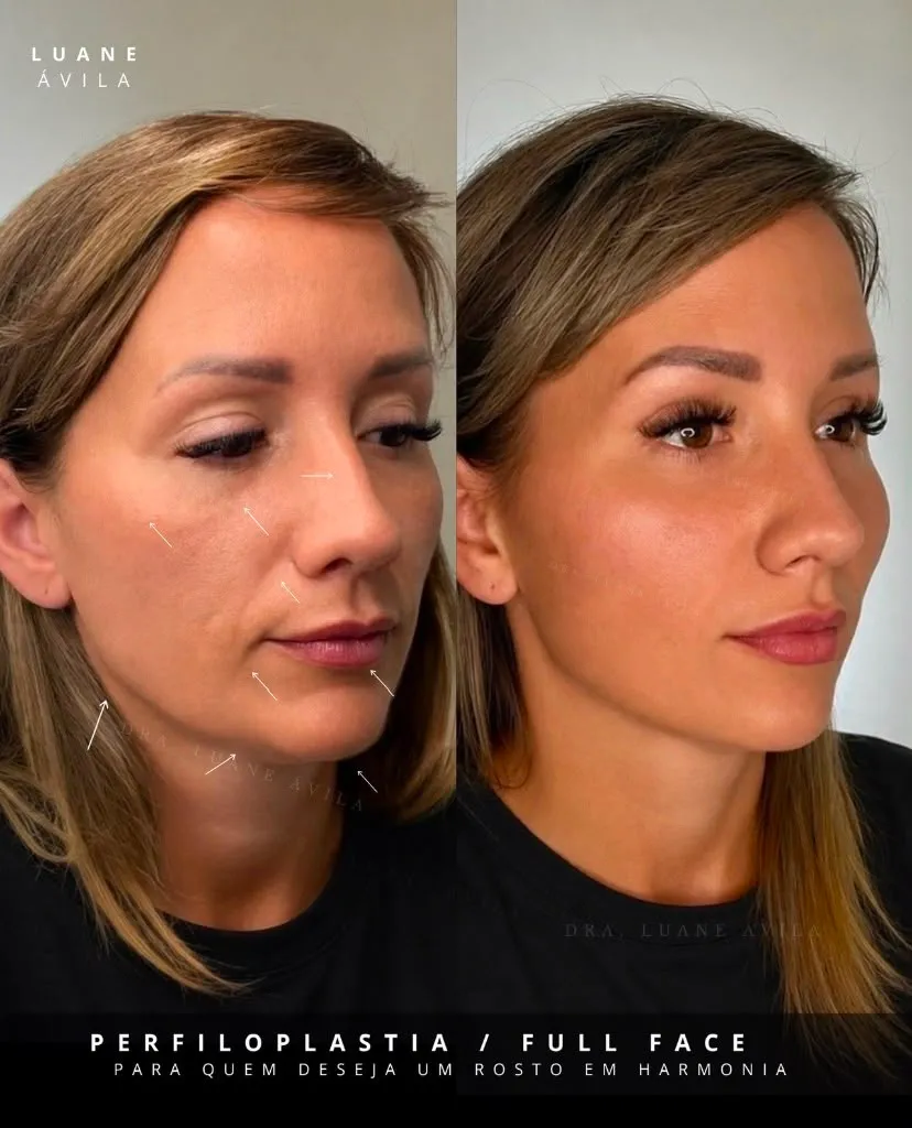 Resultado — Perfiloplastia / Full Face, antes e depois em três quartos