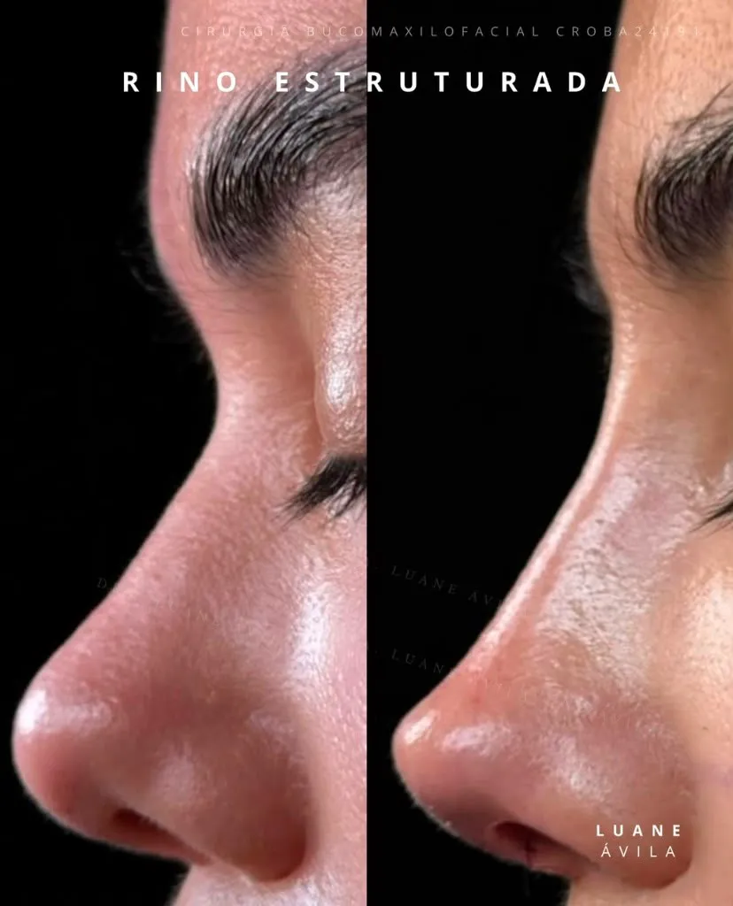 Resultado — Rinomodelação Estruturada, antes e depois em perfil